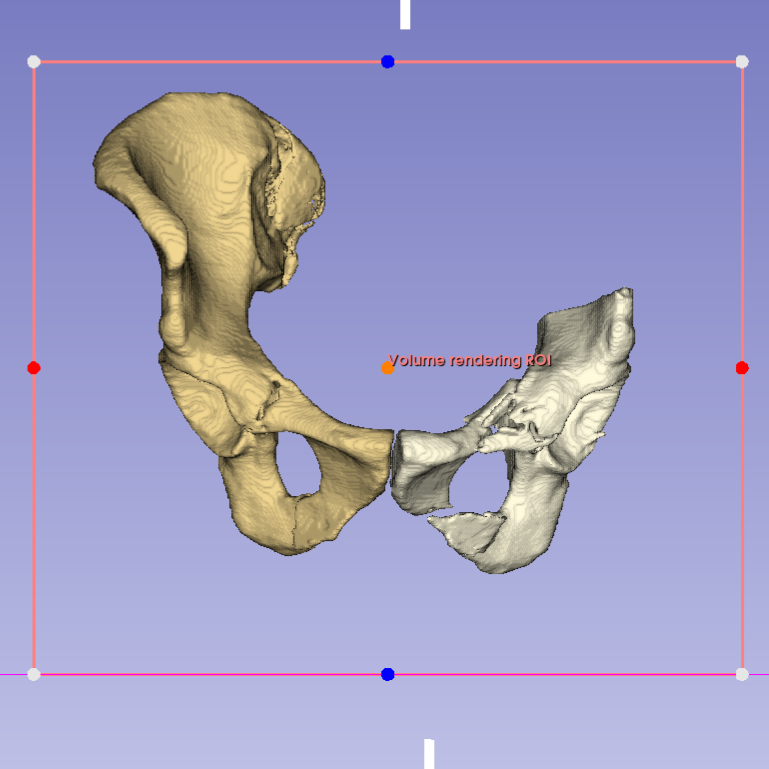 3D Slicer — Hemipelvis frontal